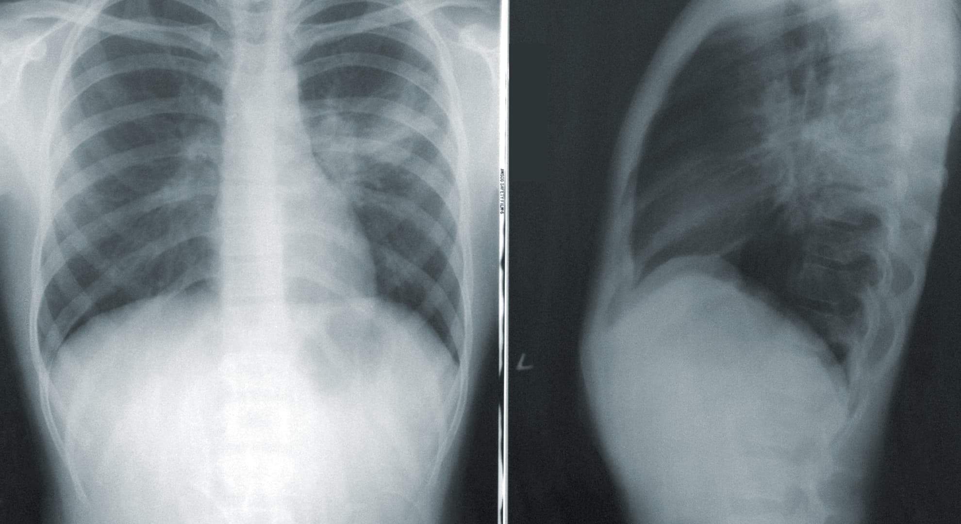 A chest x-ray showing a patient with COVID-19.