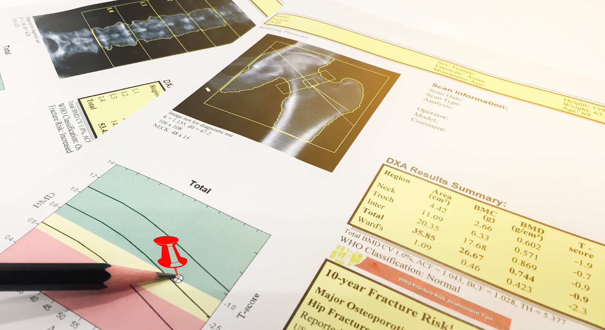 Scans and charts of a hip bone.