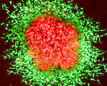 coloured close-up image of a uveal melanoma in 3D spheroid