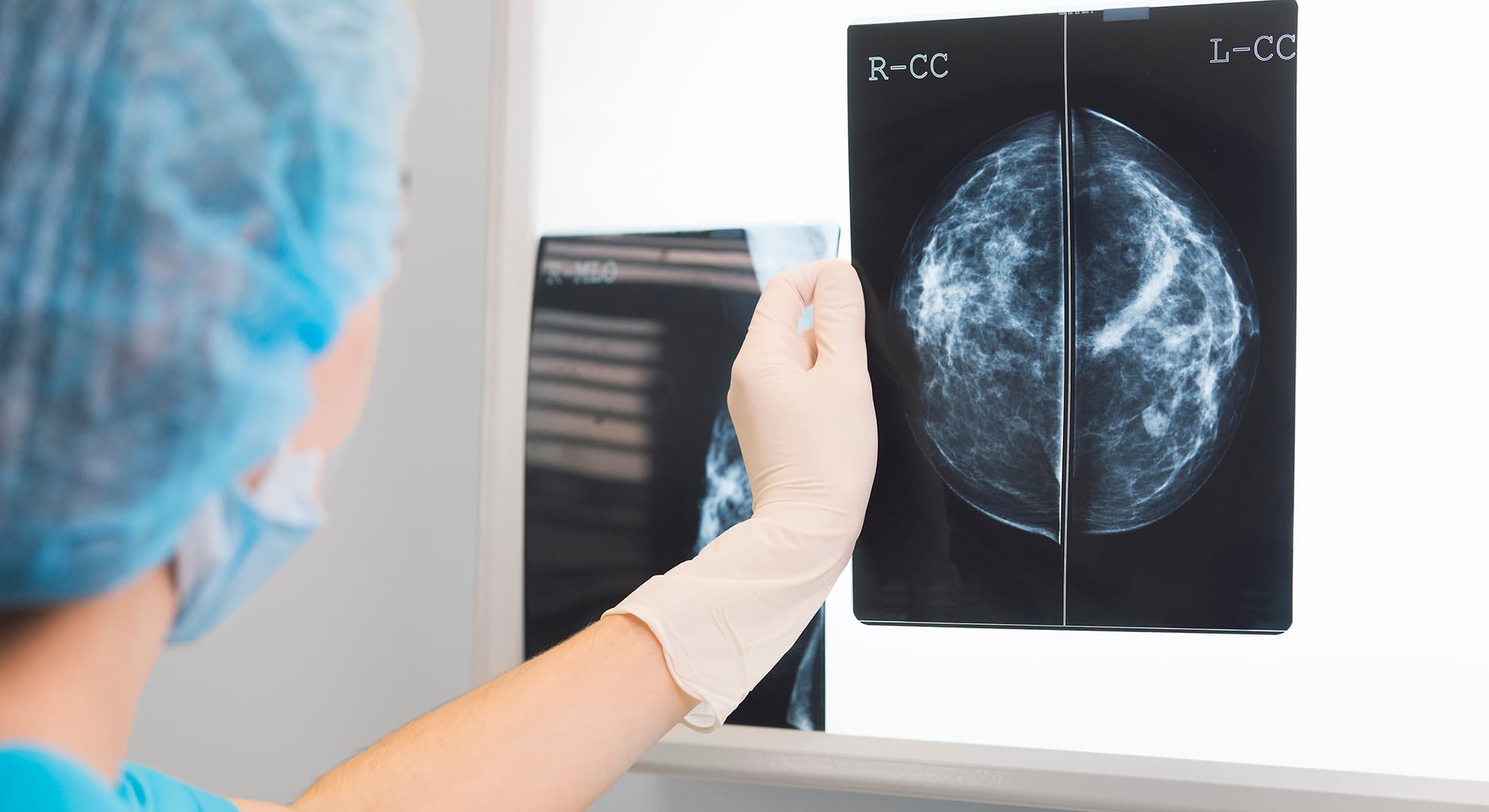 Doctor holding up scans of breasts