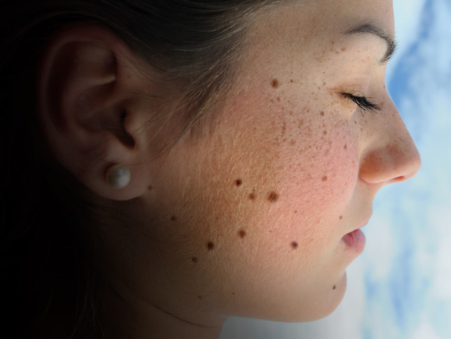 Melanoma Face-Skin Cancer-causes-Diagnosis-Treatment-Homeopathc-Allopathic-Dr-Qaisar-Ahmed-Risalpur-KPK